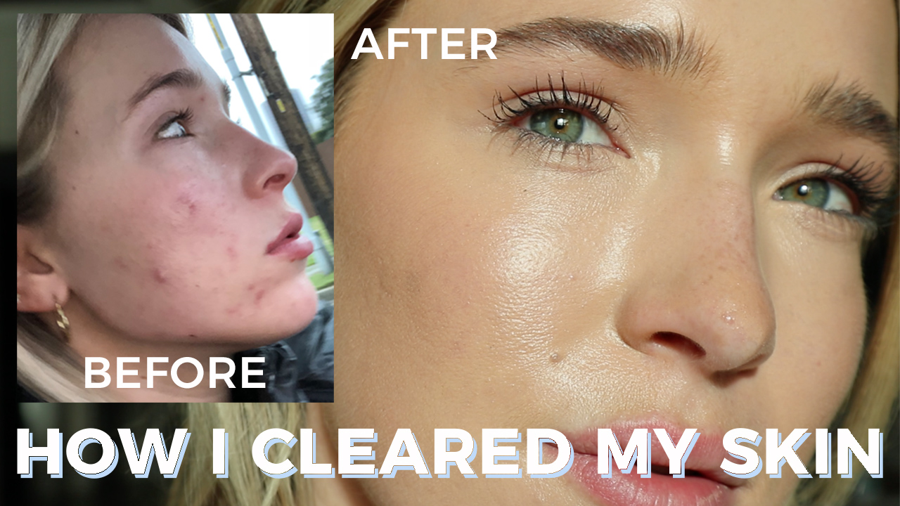 how i cleared my skin acne